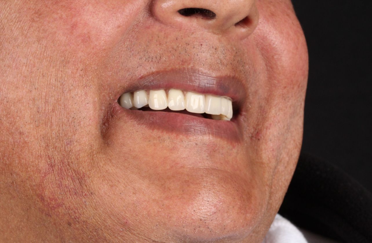Implante Dentrio em Taubat: Guia Completo para Recuperar seu Sorriso
