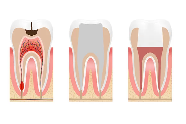 Endodontia (Tratamento de Canal)
