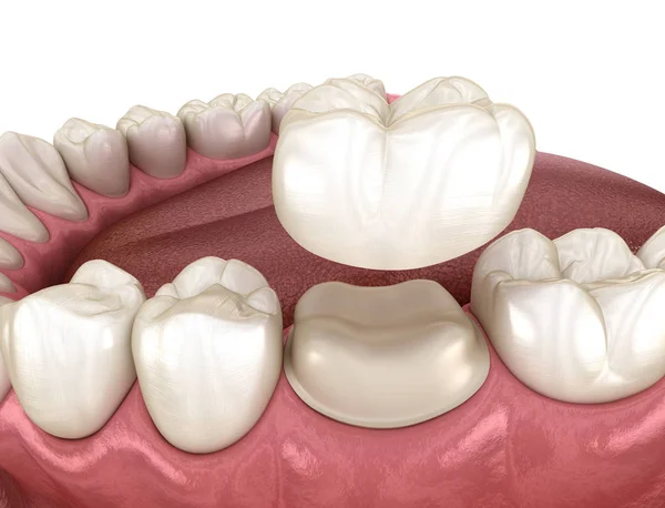 Coroa Sobre Dente: O que , quando Indicar e como Funciona