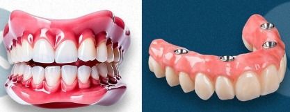 Prtese Protocolo x Dentadura Tradicional: Entenda as Diferenas e Descubra Qual  a Melhor para Voc | Edra Odontologia