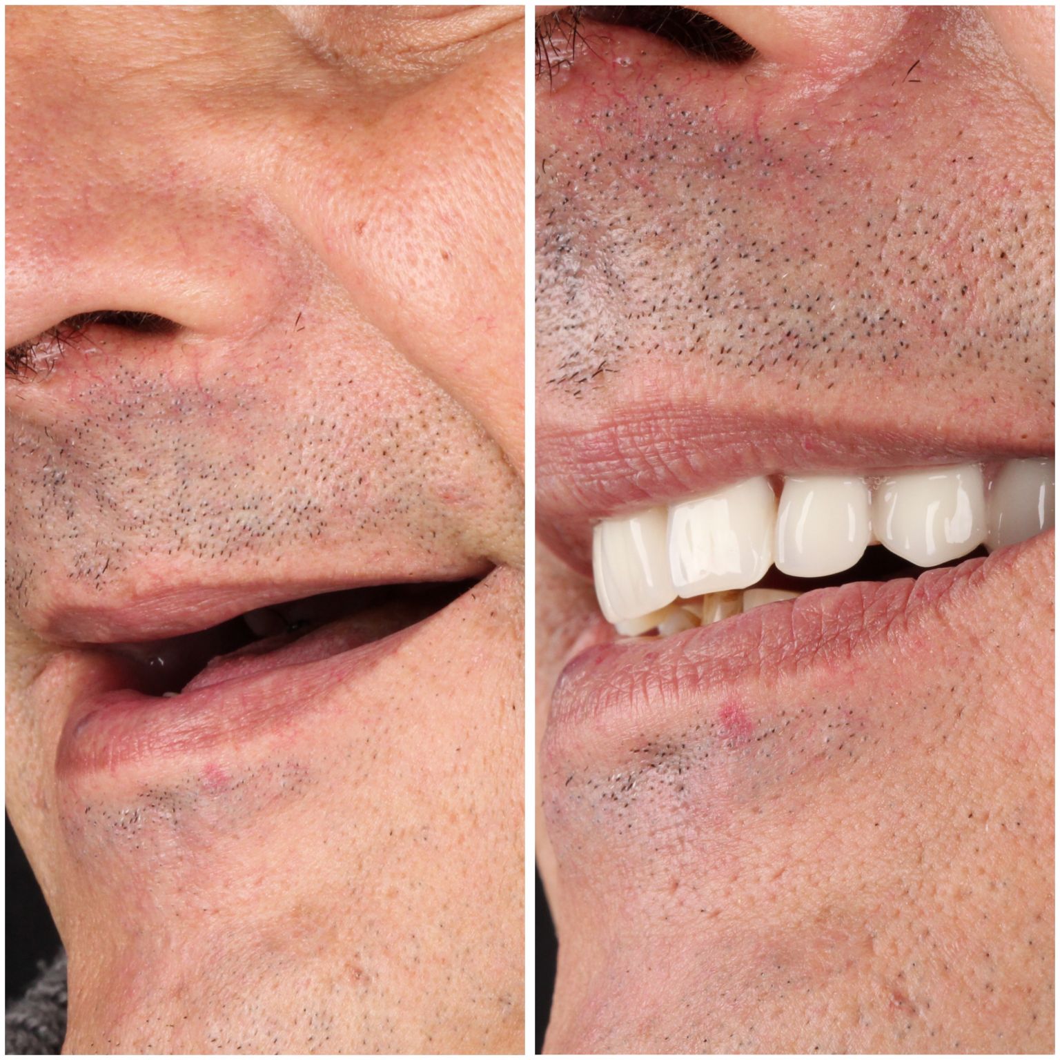 A Transformao do Sorriso com Prtese Protocolo: O Que Esperar do Antes e Depois | Edra Odontologia