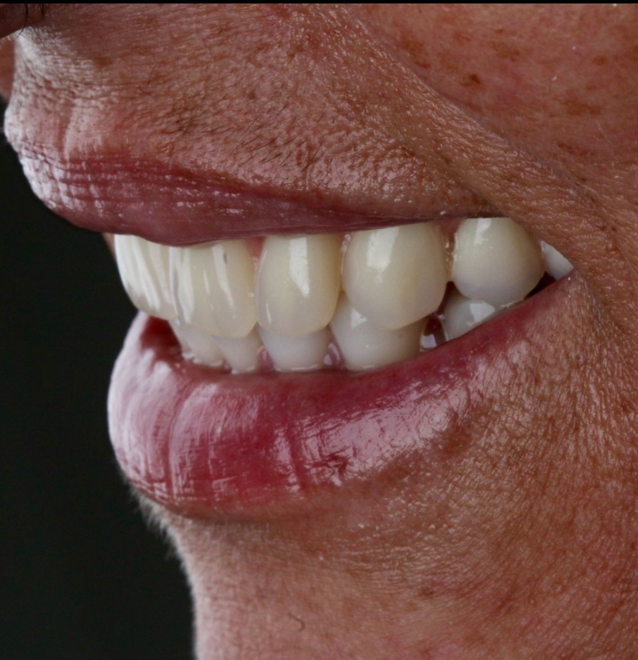 Como a Falta de Dentes Afeta Sua Qualidade de Vida (E Como a Prtese Protocolo Pode Mudar Esse Cenrio) | Edra Odontologia