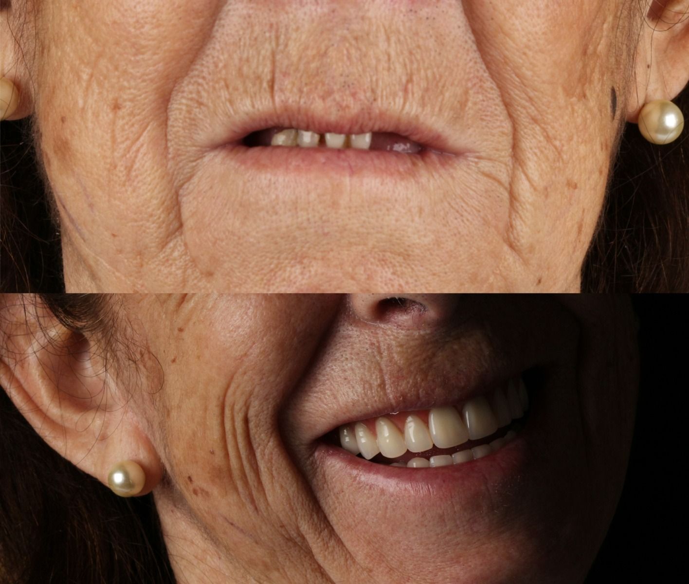 Como a Perda Dent�ria Afeta Muito Mais do que o Sorriso , e Por que Recuper�-la Transforma Vidas