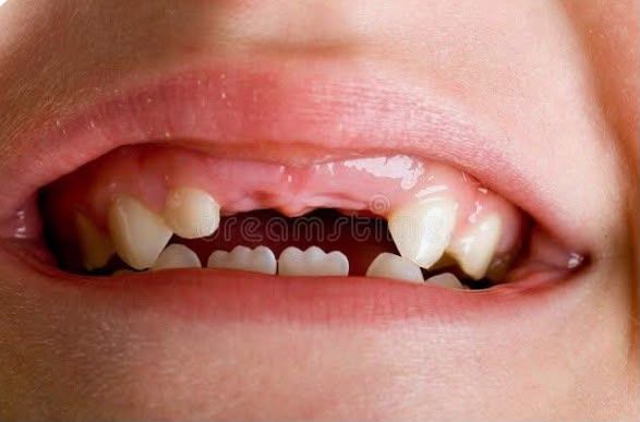 Quando a crian�a come�a a trocar os dentes de leite? O que � normal e o que merece aten��o
